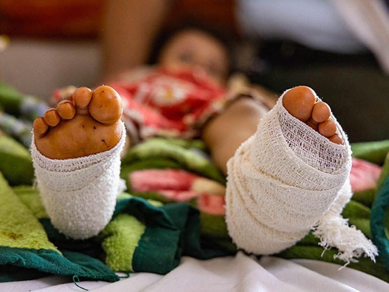 Yemen, Save the children: in media ogni due giorni bimbo ferito da mine, amputazioni e perdita vista